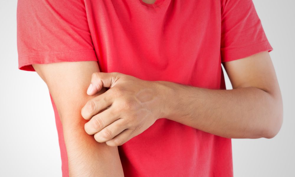 Téli ekcéma - Amikor a hideg valódi próbatétel a bőrnek